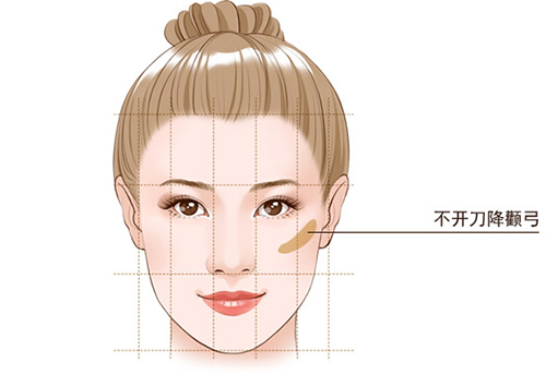 北京艺美不开刀磨骨原理是什么一针降颧骨是什么手术