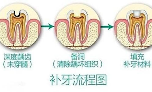 补牙流程图