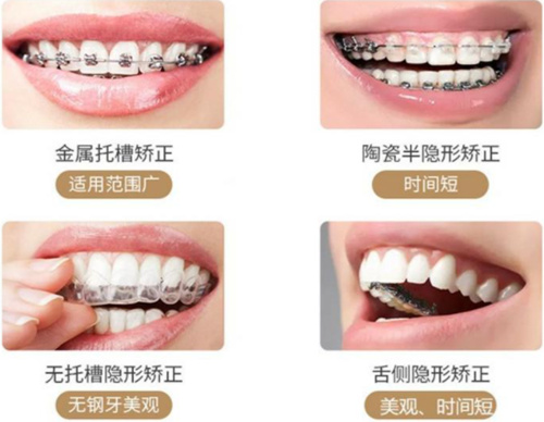 牙齿矫正器种类