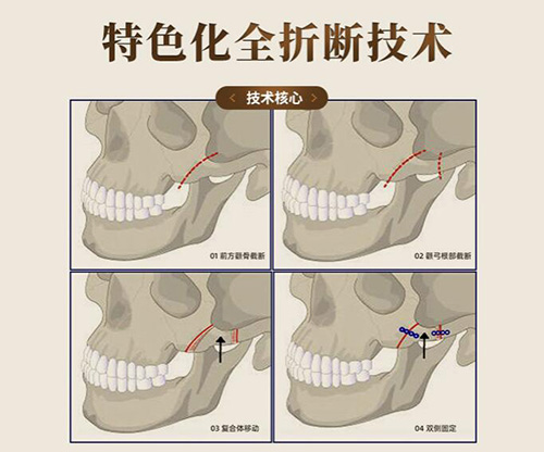 上海颧骨整形好医院合集,汇总多位上海做颧骨内推有名医生!