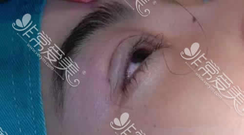 青岛割双眼皮价格曝光，这几家整形医院手术效果都不错！