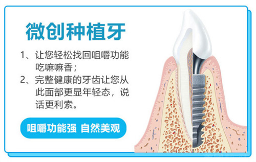 广州哪里可以免费种牙？分析广州市种一颗牙大概多少钱！