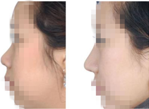 鼻部整形前后对比