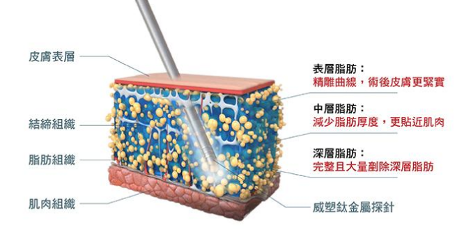 苏州吸脂手术价格是多少?揭秘苏州吸脂手术行情无套路!