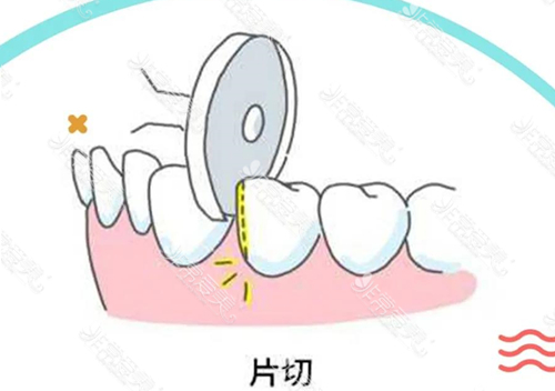 片切是什么意思？片切牙齿矫正有什么伤害吗？