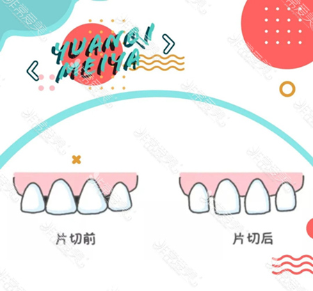 片切是什么意思？片切牙齿矫正有什么伤害吗？