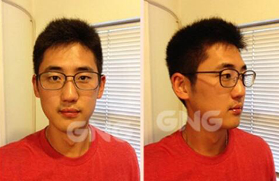 韩国GNG整形外科鼻部矫正术后照片