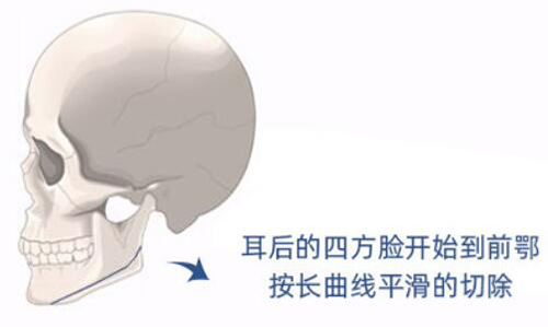 长曲线下颌骨截骨术