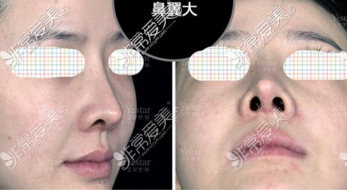 深圳艺兴文丰整形医生鼻子做得怎么样修复全过程图片欣赏