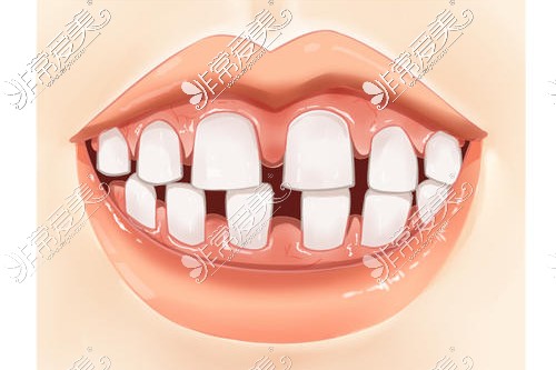 牙齿牙缝大牙齿稀疏怎么修复?可以做矫正吗?