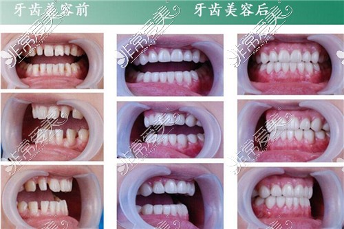 牙齿稀疏示修复对比