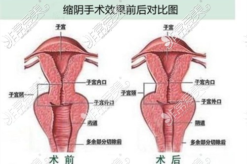 缩阴手术效果图对比