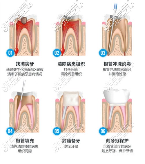 根管治疗步骤图