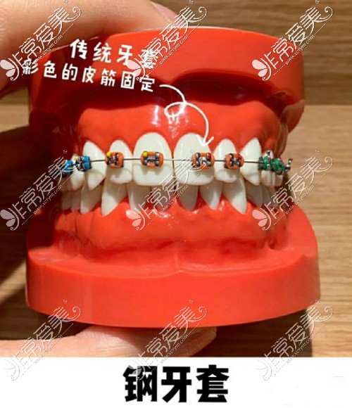 牙套的种类和价格图片公布,这份牙套价目表值得收藏!