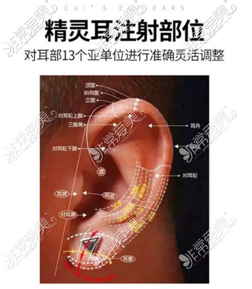 玻尿酸注射精灵耳部位展示