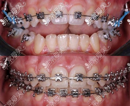 金属托槽牙齿矫正开颌效果对比