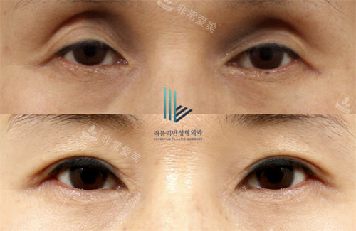 韩国乐于丽颜整形双眼皮手术对比图