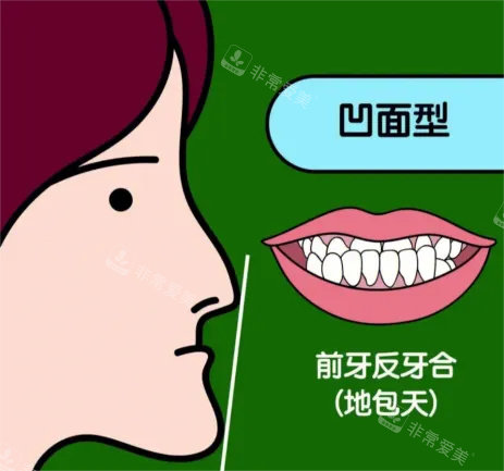 地包天漫画示意图