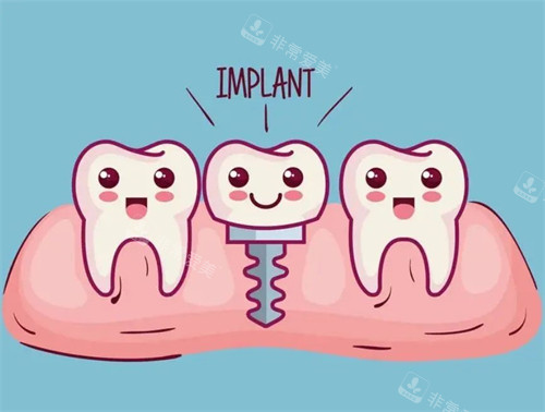 种植牙漫画示意图