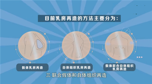 国内做乳房再造术出名的医生医院:重庆华美整形|南京美贝尔整形|成都华美紫馨整形都有胸再造有名的医生!