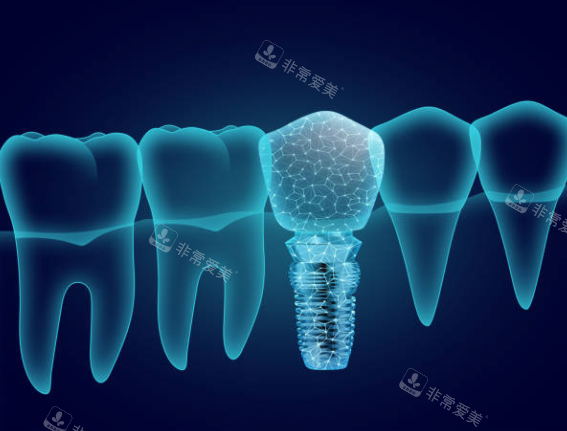 种植牙模型图卡通图