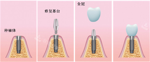 种植牙过程漫画图