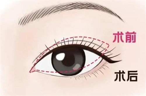 吕方中医生修复双眼皮怎么样，技术十分出色在广州人气高口碑好！