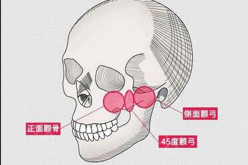 韩国颧骨缩小手术真实经历分享，术后脸型自然柔和非常漂亮！