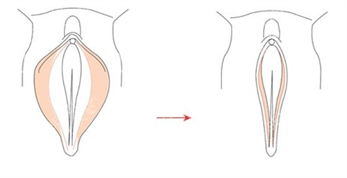 女性私密手术外阴动画展示