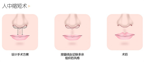 韩国做人中缩短手术技术好的医院有哪些？HB整形/优雅人整形/格林整形三家医院好的狠！
