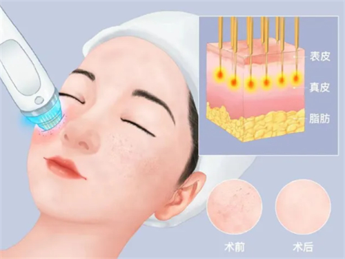 韩国做tokstic黄金微针体验感分享，做完皮肤状态非常好毛孔细腻皮肤光滑有弹性！