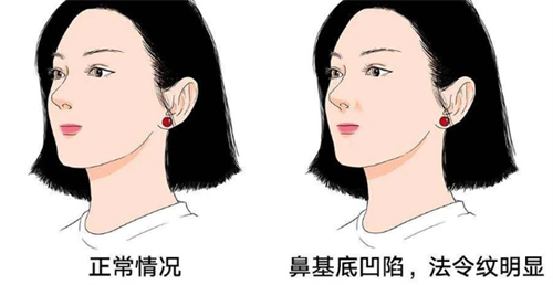济南诺德整形史瑞晶医生玻尿酸塑形怎么样?鼻基底填充立体实例_收费明细_预约流程+术后护理指南在线看!