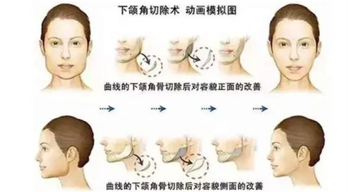 韩国做轮廓手术真实经历分享，术后面部线条流畅、脸庞精致小巧！
