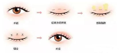 刘叶林医生简介:现任宝鸡晶肤医美院长_擅长眼鼻整形_术例库丰富可查!