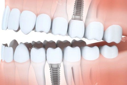 种植牙植入口腔图解