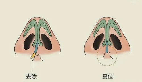 韩国魔滴二代隆胸全记录：给你们分享下从A到C是什么体验？我赌对了！