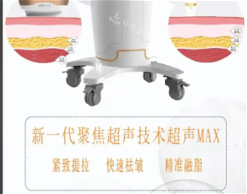 超声max作用