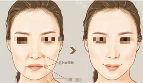 注射玻尿酸前后对比图