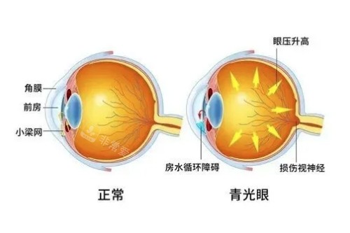 正常眼睛与青光眼概念对比图