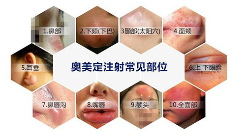 网选国内取面部异物的正规医院排名:广州荔医整形/北京煤医整形/上海伯思立整形/广州海峡整形清奥干净！