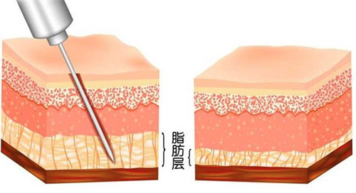 韩国seroi整形医院怎么样?擅长做吸脂手术且口碑好,分享简介介绍+口碑评价!