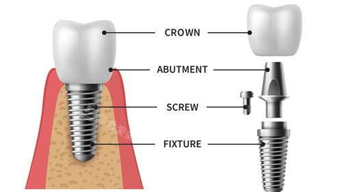 种植牙组成部分动画展示