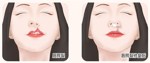 韩国唇腭裂可以做人中吗？韩国可以鼻子+人中+嘴唇同时进行修复！