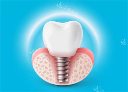 种植牙有光圈示意图