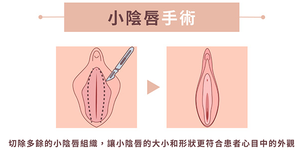 韩国做阴唇整形真实经历分享，术后结果很满意阴唇的大小和形状变得很美观！