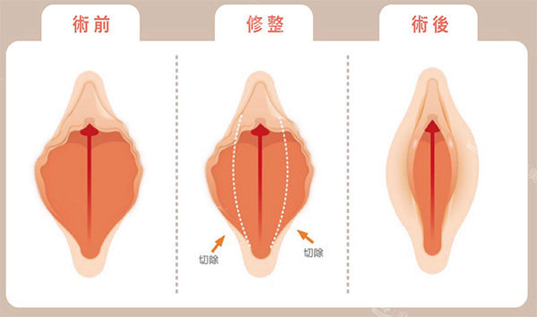 外阴唇切除术前术后