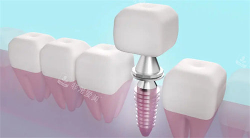 种植牙透视动画展示图