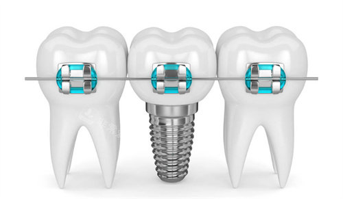 种植牙牙齿矫正图片