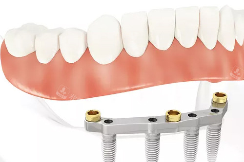 半口种植牙联排牙冠示意图