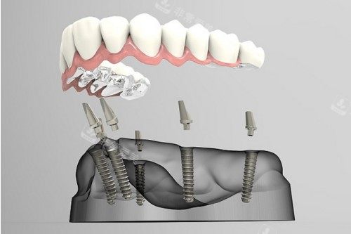 all-on-6种植卡通一览图